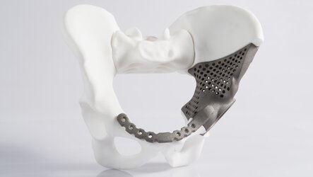 Alphaform Produces Metal 3D Printed Hip Implant 